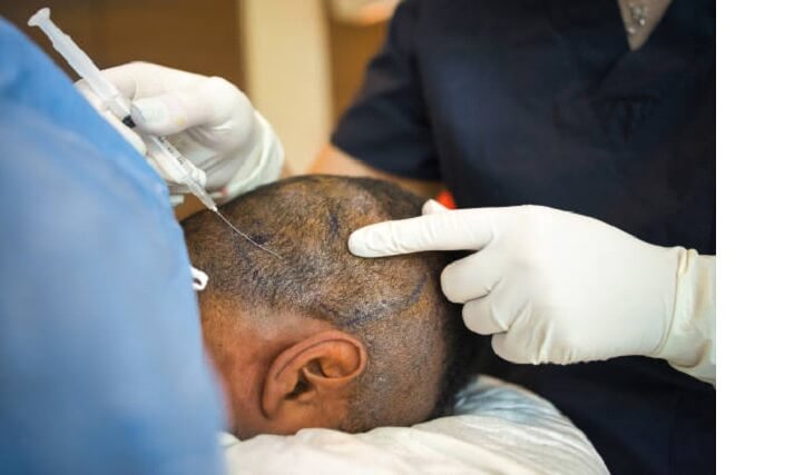 How much does Hair Transplant Cost