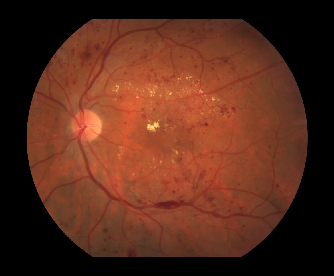 What is diabetic retinopathy