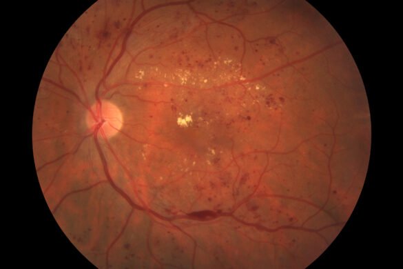 What is diabetic retinopathy