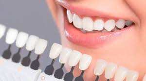What to Expect When Getting Porcelain Veneers